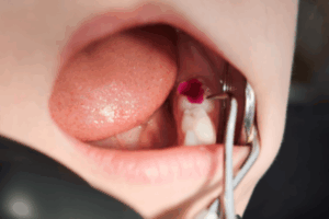 Broken Dental Fillings: What You Need to Know