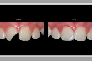 The Four Symptoms of a Broken Dental Filling
