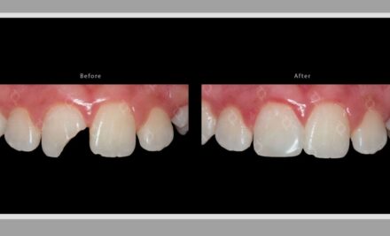 The Four Symptoms of a Broken Dental Filling