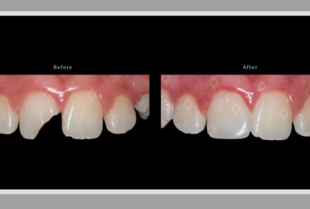 The Four Symptoms of a Broken Dental Filling