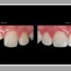 The Four Symptoms of a Broken Dental Filling