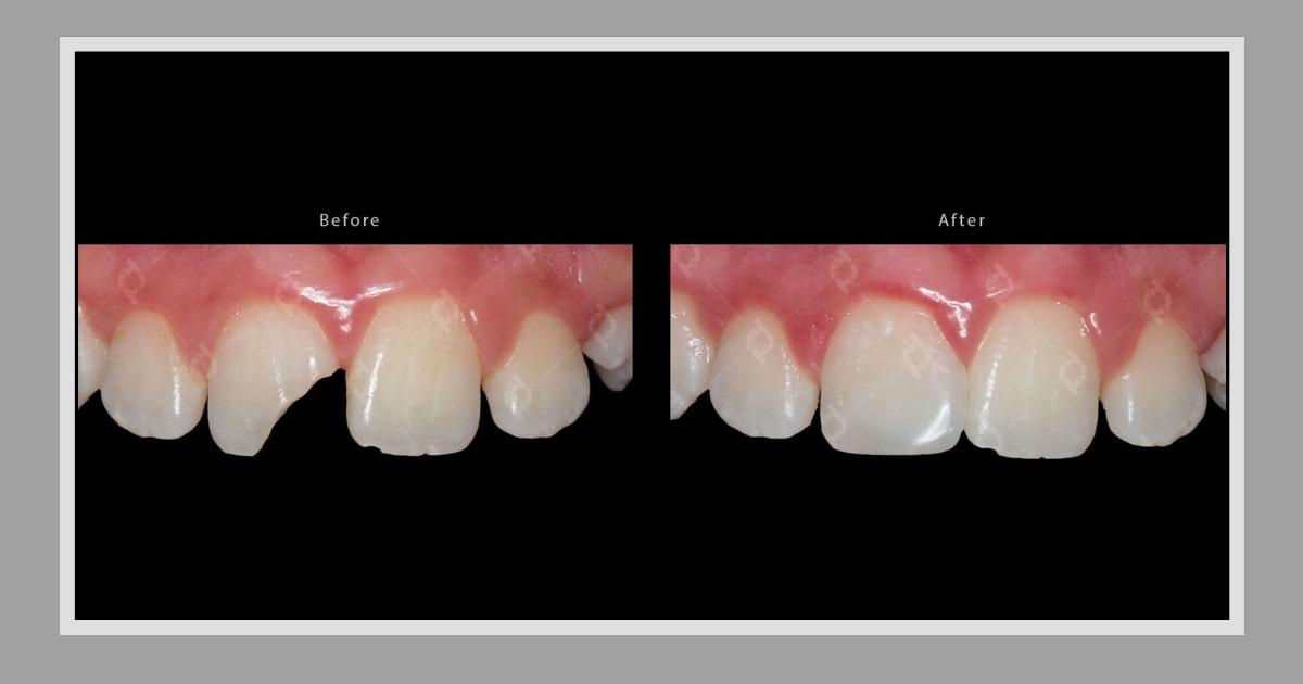 The Four Symptoms of a Broken Dental Filling