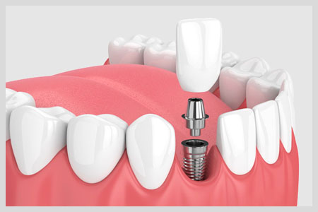 Veneers Cost_images - blyss-dental-veneers-cost-porcelain