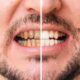 What Are the Benefits of Getting Full Mouth Dental Implants?