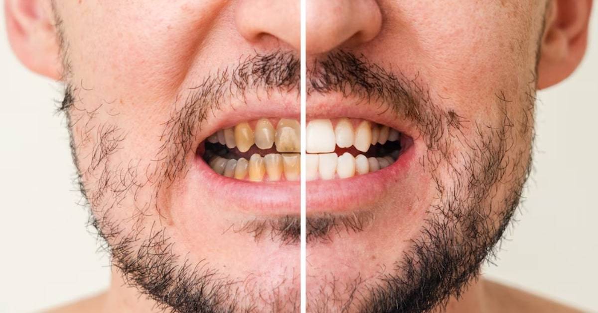 What Are the Benefits of Getting Full Mouth Dental Implants?