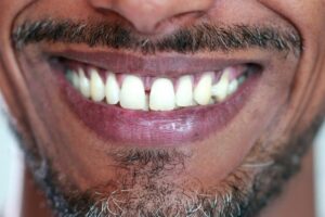 Veneers vs. Implants: What is the Best Option?