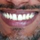 Veneers vs. Implants: What is the Best Option?