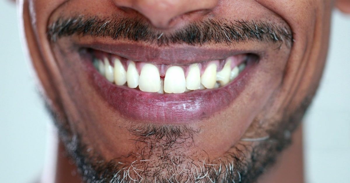 Veneers vs. Implants: What is the Best Option?