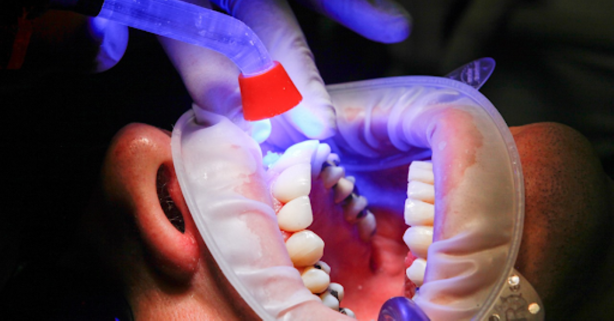 How Long Does Professional Teeth Whitening Last