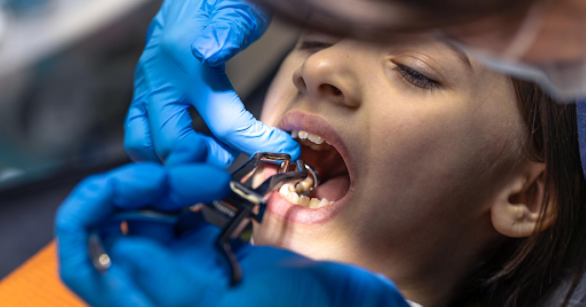 What to Do If You Have a Cracked Filling 